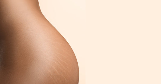 How to Reduce Stretch Marks: A Realistic Approach That Works